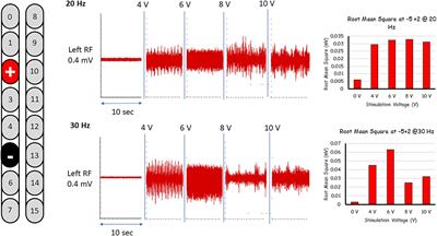 Interleaved configurations of percutaneous epidural stimulation enhanced overground stepping in a person with chronic paraplegia